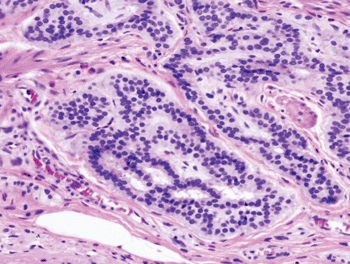 Image: Histopathology of colonic carcinoid stained by hematoxylin and eosin (Photo courtesy of Wikipedia).